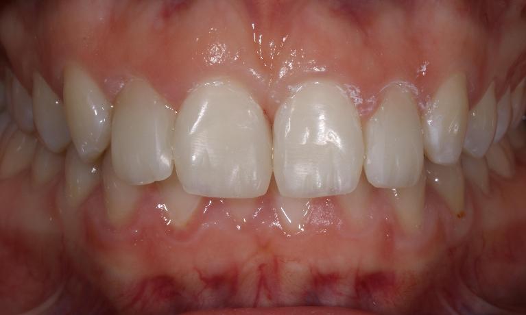 Composite-Veneers-After-Image