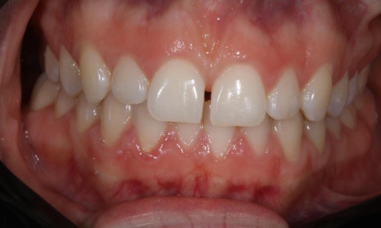 Composite-Veneers-Before-Image